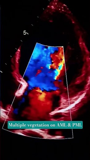 MULTIPLE VEGETATION SEEN ON AML & PML. #echocardiography #heartdisease