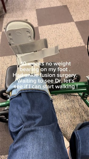 10 Weeks Post OP: Walking Again After Ankle Fusion