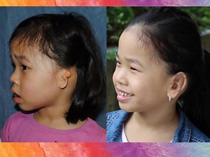 50 reactions · 15 comments | It is important to view before and after ear reconstruction photos from every angle. Sophie loves her big ear! #microtia #earsurgery | Dr. Sheryl Lewin, Microtia Ear Surgery | Facebook