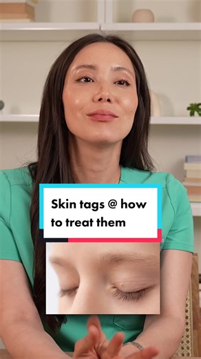 Skin tags are cute until they're not. Or maybe they're never cute. Please don't try to remove them at home! #skintag #skincare #skincaretreatment #dermatologist #derm #skintagremoval