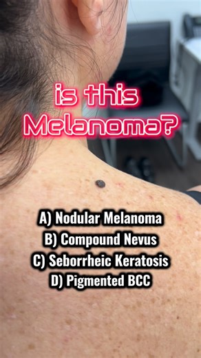 Dr. Mathieu Powell, MD on Instagram: "Melanoma or not Melanoma? 🎭 That is the Question!💡 👉 Answer: B — Compound nevus. A lot of people get anxious when a mole is raised — but height alone doesn’t make it dangerous. In fact, most raised moles are benign, though they still deserve monitoring. 🫨 This bump is soft and wobbly — the wobble sign — a reassuring clinical clue often seen in benign intradermal or compound nevi. 🔬 Under dermoscopy, you see a symmetrical architecture, uniform brown pigm