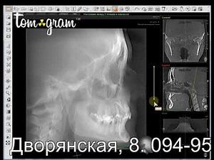 Строим телерентгенограмму(ТРГ) из КТ