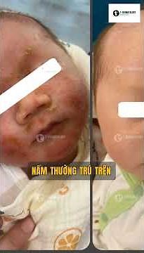 ông bà mình gọi là cứt trâu trên đầu trẻ…thực ra là một bệnh da liễu cần hiểu đúng, không xử trí sai