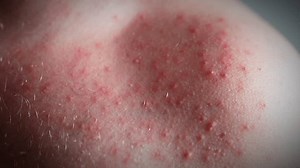 Close-up shot of skin rashes and pimples on human shoulder, red itchy spots being an allergy reaction on food, medicine, stress, imbalanced hormones, cancer disease, some chemicals or unhygienic