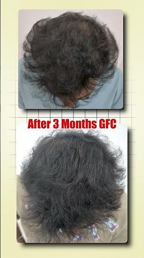 GFC Hair Treatment Result 🤯 Growth Reveal!✨