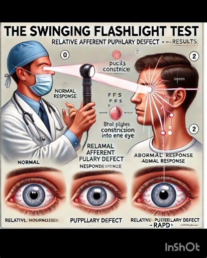 "THE SWING FLASH LIGHT TEST"#eyes #optometry #visioncare #eyecare #optometrist #healthcare #sight
