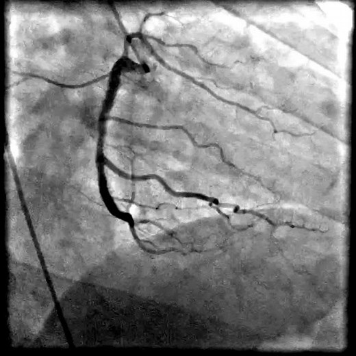 Coronary angiography femoral artery