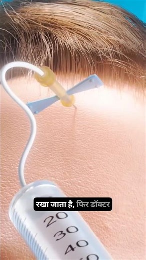 Forehead Shrinking Surgery 😄 #reels #reelitfeelit #reelsindia #viral