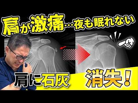 Severe pain! Causes and treatment of calcific tendonitis of the shoulder [A thorough explanation ...