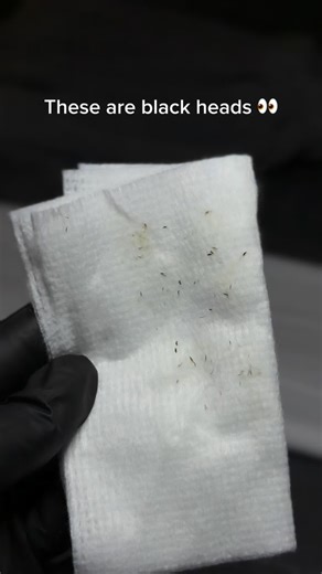 What actually causes blackheads? 🖤 Blackheads form when pores become clogged with excess oil (sebum), dead skin cells, and debris. When this buildup is exposed to air, it oxidizes—turning dark. Hormonal changes, overactive oil glands, heavy or pore-clogging products, and skipping exfoliation can all contribute. The good news? Consistent exfoliation, proper cleansing, and professional treatments can help keep pores clear and skin smooth ✨ ☎️ (702) 625-3838 📍 Las Vegas, NV 🌐 Beautygoalslv.com |