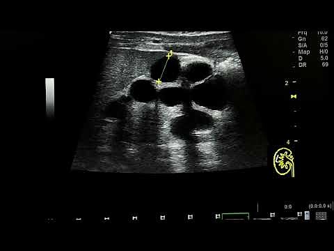 multicystic dysplastic kidney ultrasound case in a newborn