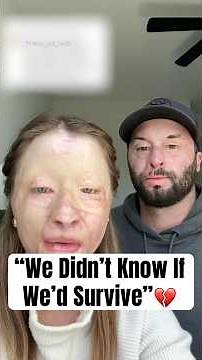 This Couple Survived A Fire #shorts #BurnSurvivors #burnrecovery