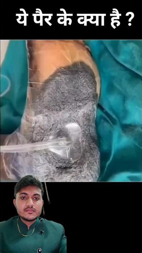 fast wound healing #woundhealing #vaccumehealing #fasthealing #therapy