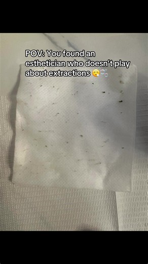 POV: You found an esthetician who DOES NOT skip extractions 👀🫧 #blackhead #SacramentoFacials #Extractions #SacramentoSkincare #Facials