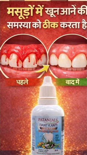मसूड़ों से खून और सूजन का पक्का इलाज! 🦷 Patanjali Dant Kanti Gum Paint Review #Shorts