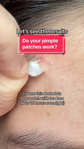 I Wore Dododots Pimple Patches Overnight: Results Revealed!