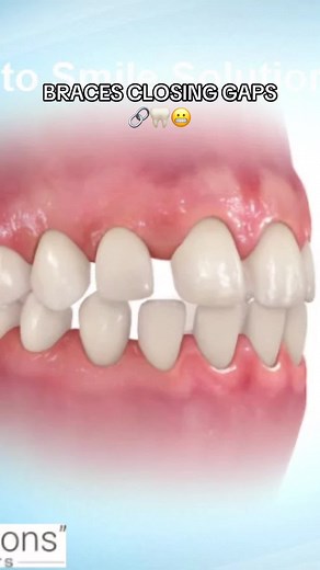 Braces for Closing Gaps Between Teeth