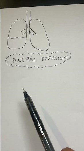 Pleural Effusion Explained in 1 minute!