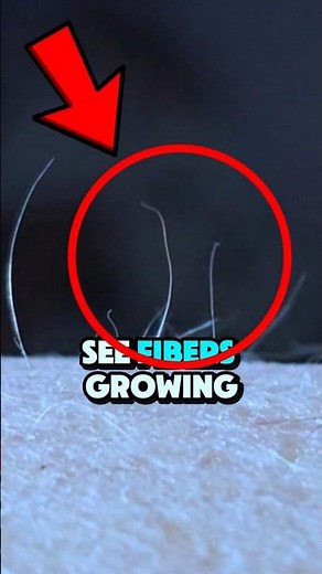 “What’s Crawling Under My Skin? Morgellons Explained”