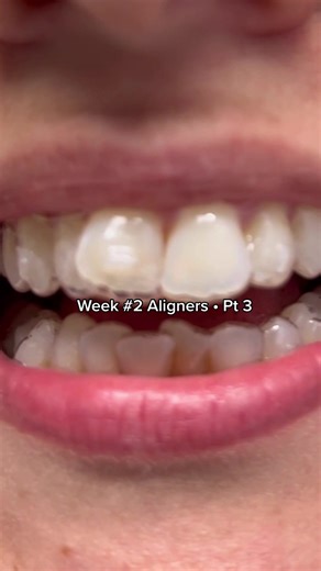 Week 2 Clear Aligners: Changing Trays | Invisalign Journey