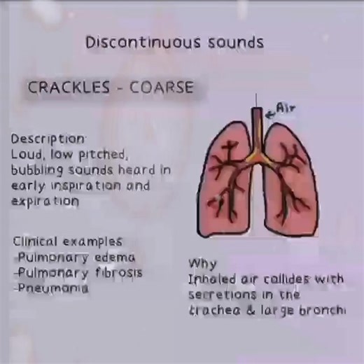 Master lung sounds! Coarse crackles are abnormal lung sounds characterized by discontinuous, low-pitched, bubbling, or gurgling noises heard primarily during inhalation. They are caused by air passing through fluid, mucus, or secretions in the larger airways. #crackle #coarse #lungsounds
