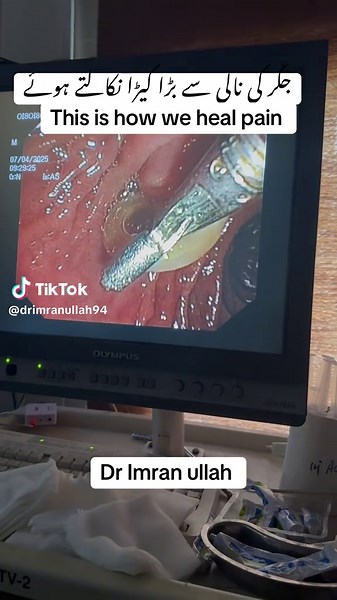 ERCP Procedure for Removing a Large Bile Duct Worm