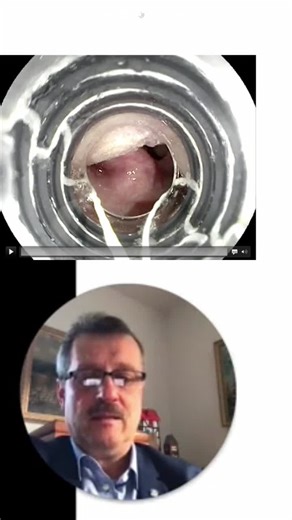 #gastroenterology #gastroenterologia #endoscopy #endoscopia #esophagealsphincter | EndoCollab™ | Gastroenterology & Endoscopy Education