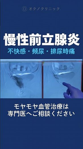 Chronic prostatitis: discomfort, frequent urination, pain during urination