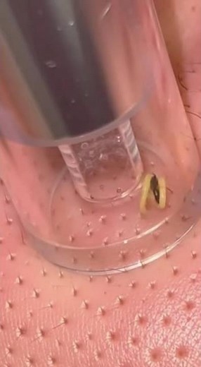 Botfly Larva Removal: Detailed Extraction of Human Parasite from Skin