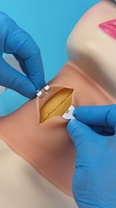 How tracheostomy is done | 5-Minute Crafts Men