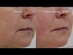 Hifu Facelift Treatment Before and After Eskulap Clinic London and Birmingham