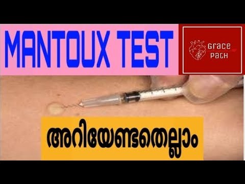 Mantoux Test / Tuberculin Skin Test (TST) (Malayalam)