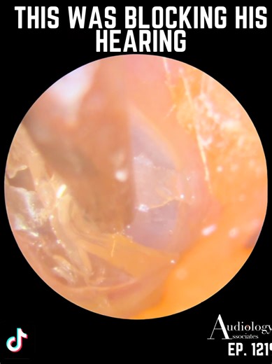 Instantly Improved Hearing After Earwax Removal