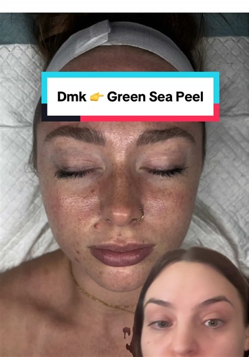 Acne Treatment Sequence: DMK Enzyme Therapy & Green Sea Peel