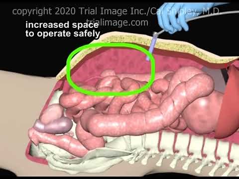 Setup for Laparoscopic Pelvic Surgery Animation by Cal Shipley, M.D.