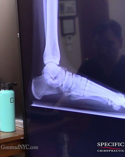 His Foot X Ray Explained Everything