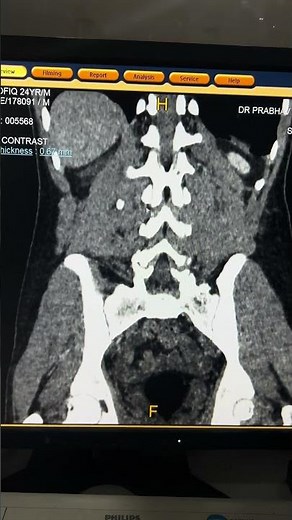 Understanding Pyelonephritis Through CT Scans: Key Insights