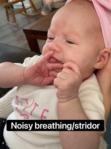 Baby with Tracheomalacia