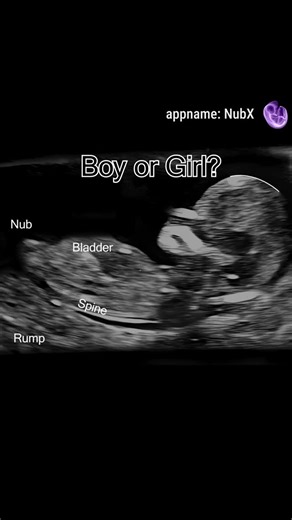 NubX: Gender Reveal & Baby Scan | Is it a baby boy or a baby girl? 💖🍼 #nubx #nubxapp #genderreveal #babyboy #babygirl | Instagram