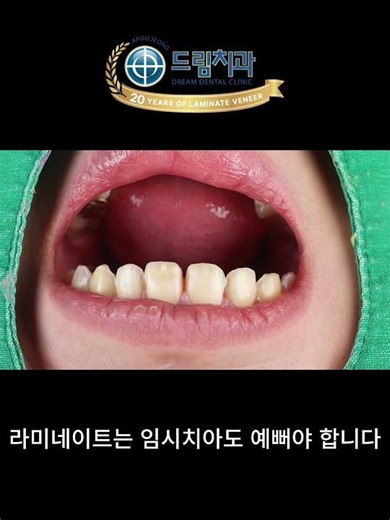라미네이트의 임시치아 laminate veneer temporary