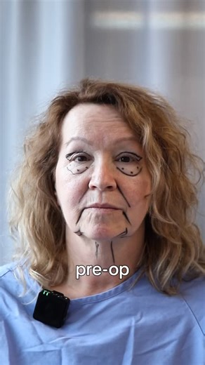 Dr. Sinno | Montreal Plastic Surgeon on Instagram: "Healing is a journey, not a sprint. ✨ This incredible 10-month transformation shows the power of combining structural surgery with skin resurfacing. By addressing the deep tissue, restoring lost volume, and refining the skin’s surface, we achieve a result that looks natural—never “done.” • Day 1: The peak of swelling. • Day 7 & 16: Navigating the “messy middle” of healing. • Post-CO2: Addressing texture and fine lines. • 10 Months: The final, s