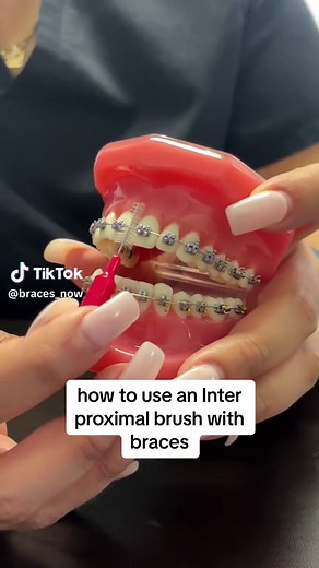 Here’s how to use an interproximal brush (AKA proxabrush) with braces! #fyp #trending #dentaleducation #braces #adultbraces #teenbraces #bracesnow #proxabrush #flossing #healthyteeth #orthodontist #orthodontics #crossbite #overbite #underbite #overbite #deepbite #gwinnettcounty #bufordclips #bufordga #norcrossga #howto #howtovideo