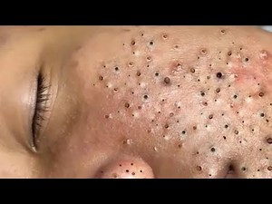 Professional facial Acne treatment #blackheads &whiteheads removal with the nasa#013