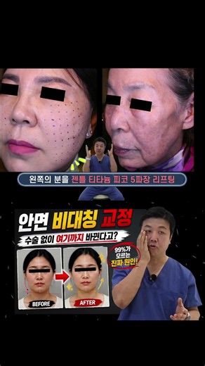 Facial asymmetry without surgery? Really?! #FacialAsymmetry #PlasticSurgerySideEffects #Asymmetry...