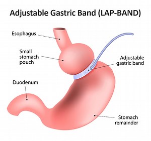 Gastric Banding in Mexico (LAP-BAND)