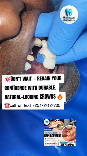 Regain Your Confidence with Durable Dental Crowns