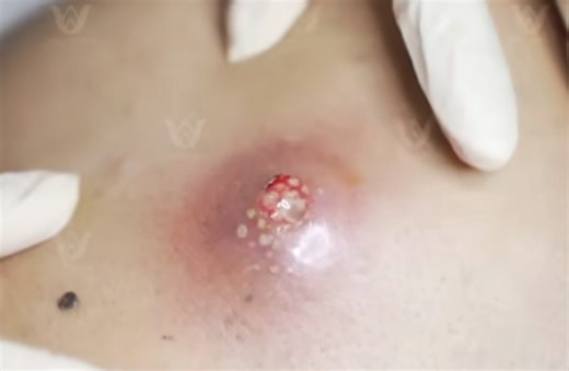 Large Infected Cyst Incision and Drainage