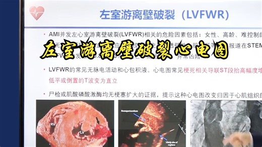 61.左心室游离壁破裂心电图表现