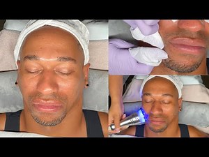 Bro Facial | Mens Facial with Extractions | Ultrasound & High Freq