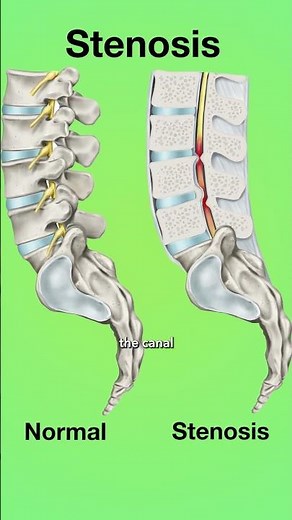 What Is Spinal Stenosis? #surgeon